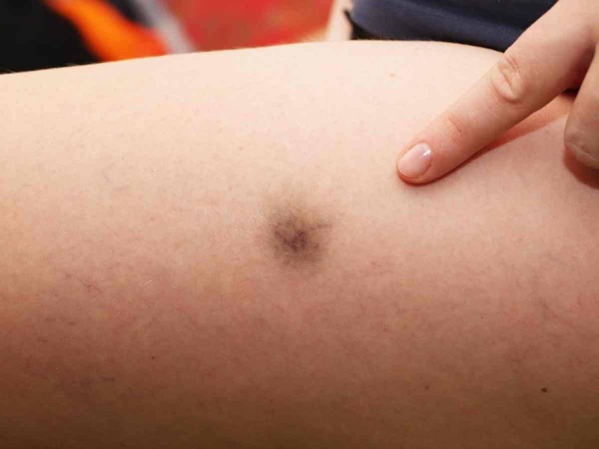 7 Common Mounjaro Side Effects Nobody Warned You About mounjaro side effect thigh bruising